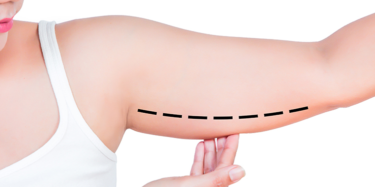 BRACHIOPLASTY (ARM LIFT)
